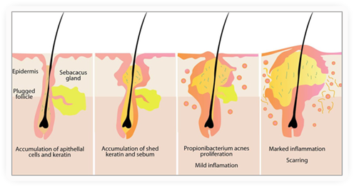 Acne Scarring And Blemish Treatment - Bangkok Aesthetic Clinic