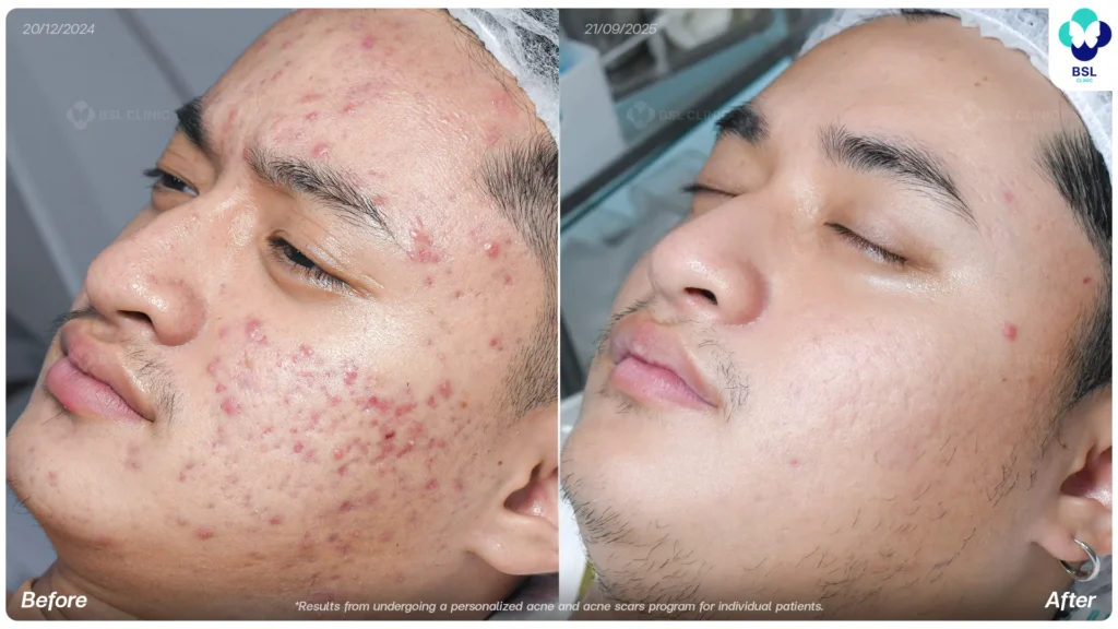 acne scar treatment at BSL Clinic
