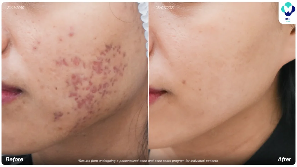 acne scar treatment at BSL Clinic