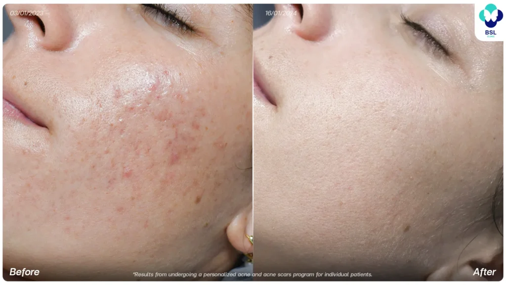 acne scar treatment at BSL Clinic