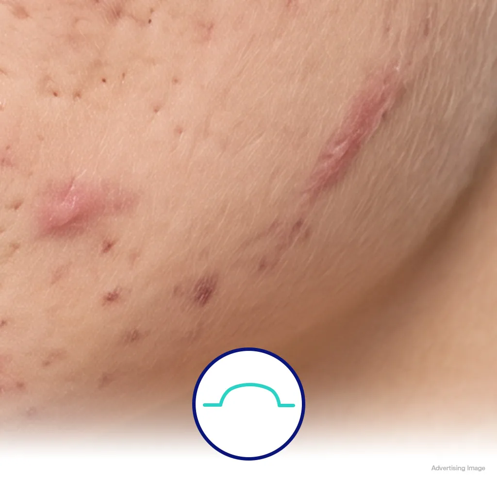 Keloid Scars