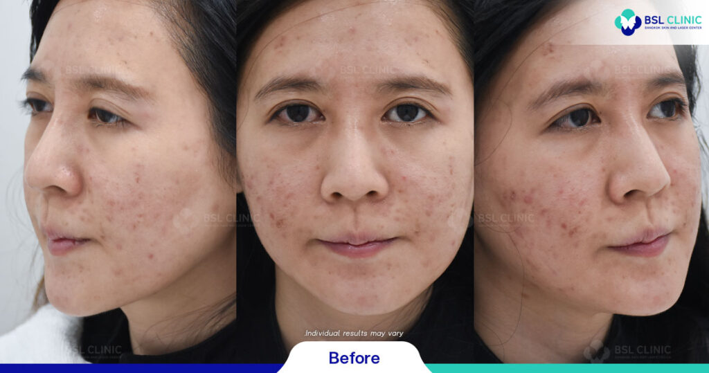 Acne Scarring And Blemish Treatment