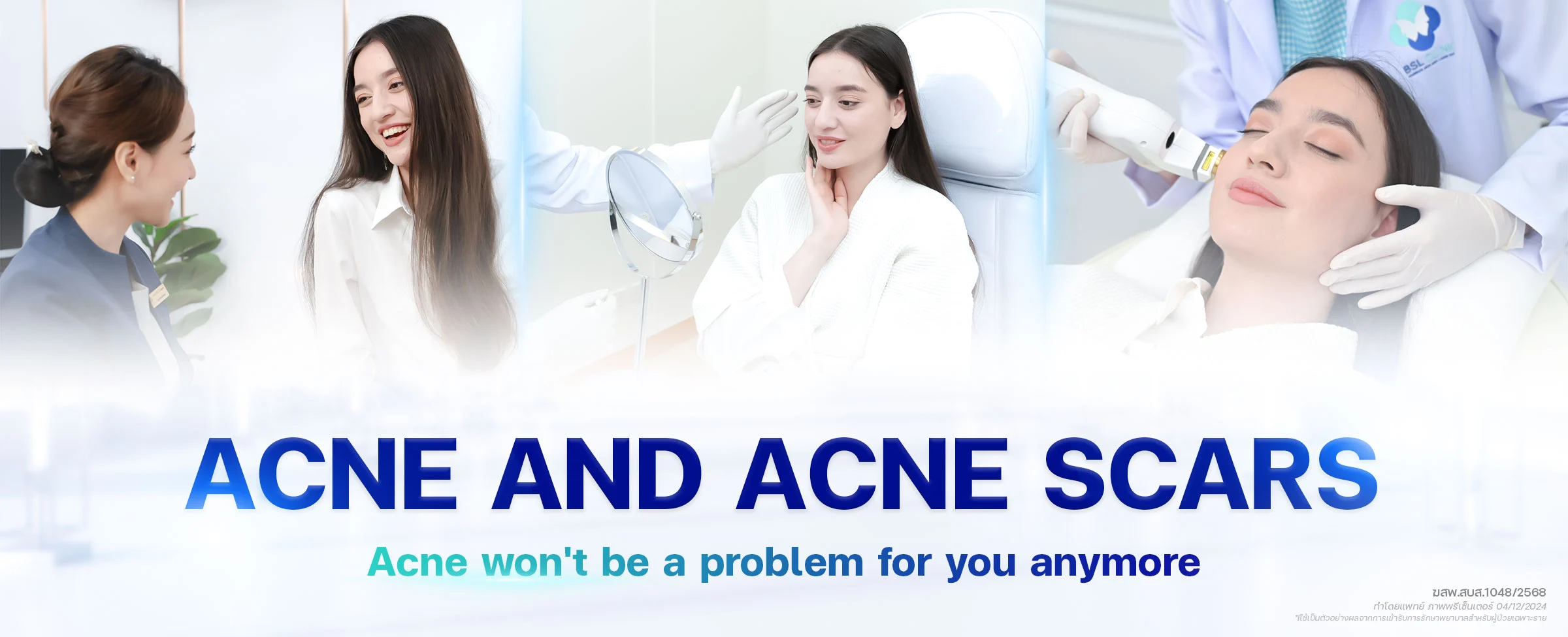 Acne-and-Acne-scars