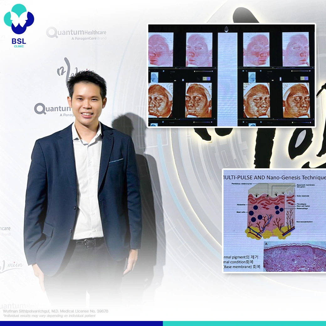 อัพเดตเทรนด์ เลเซอร์ รักษาฝ้า ลดเม็ดสี BSL Clinic