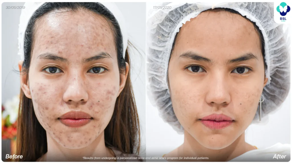 Acne treatment before and after at BSL Clinic Bangkok