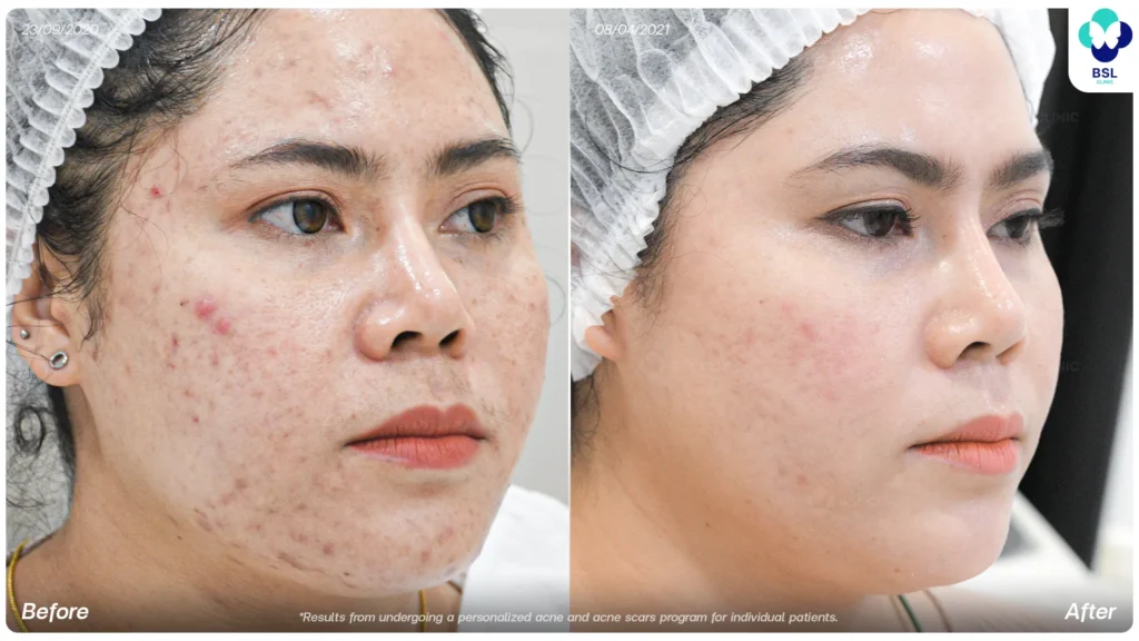 Acne treatment before and after at BSL Clinic Bangkok