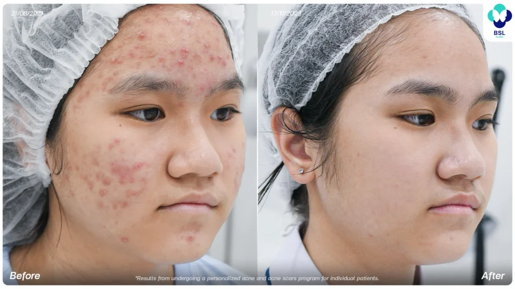 Acne treatment before and after at BSL Clinic Bangkok