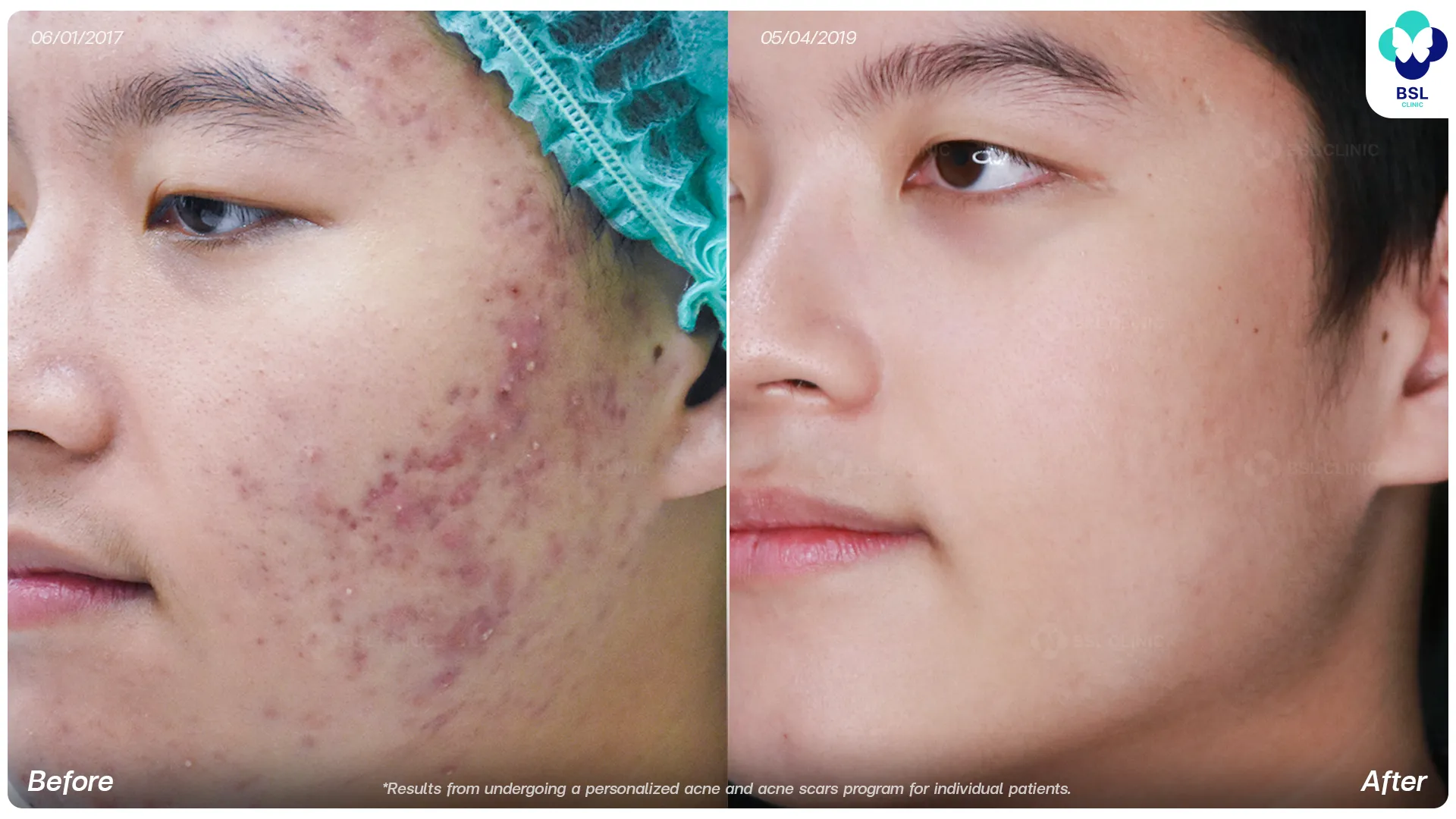 Acne and acne scars before and after treatment