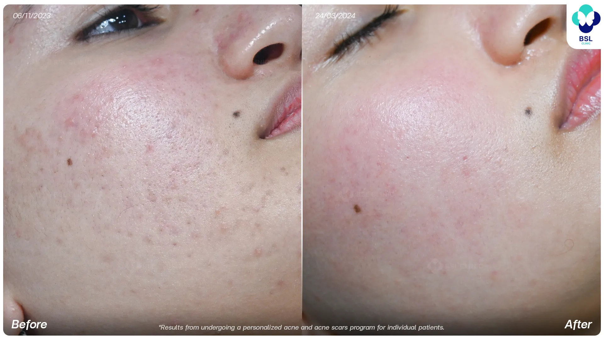 Acne treatment before and after at BSL Clinic Bangkok
