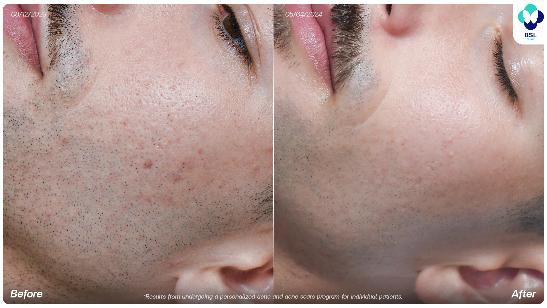 recurring breakouts before and after treatment