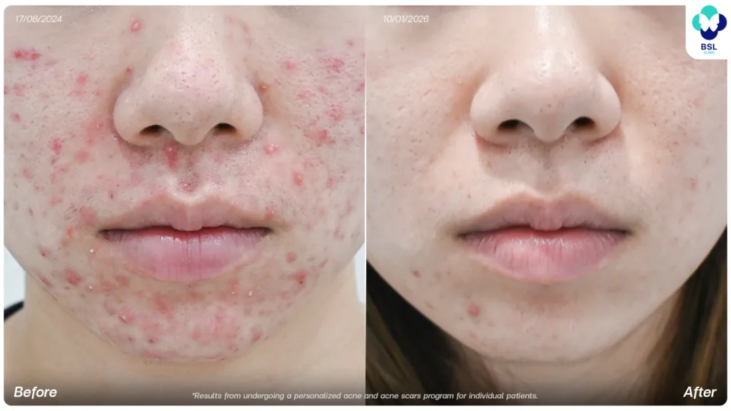 Acne treatment before and after at BSL Clinic Bangkok