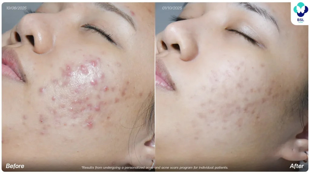 Acne treatment before and after at BSL Clinic Bangkok