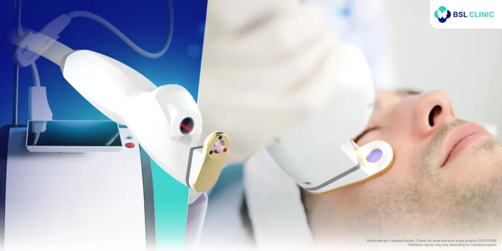 AviClear laser acne treatment procedure
