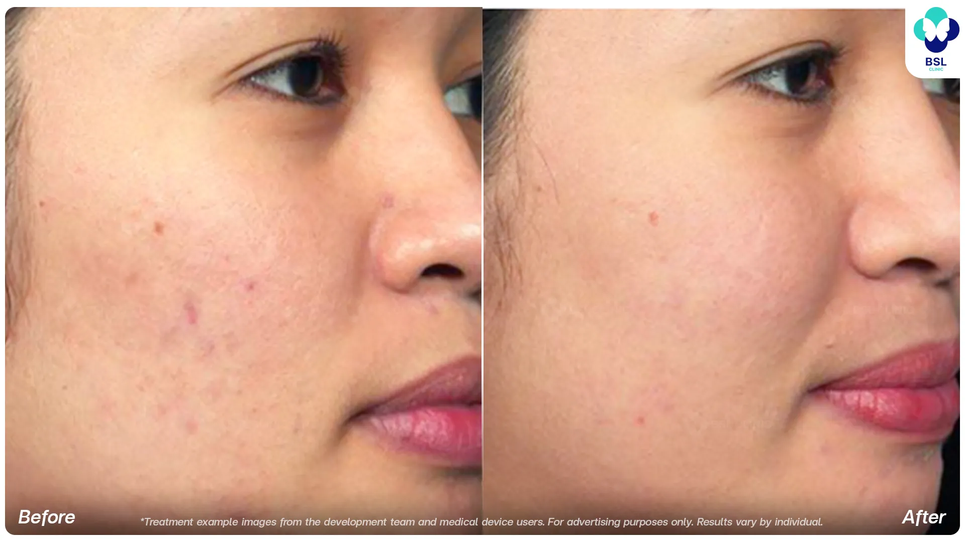 Fraxel Dual before and after skin texture