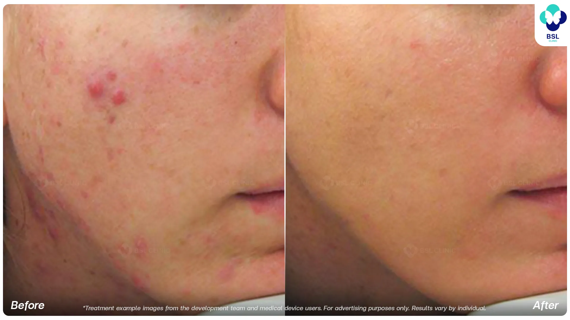 Fraxel Dual before and after skin texture