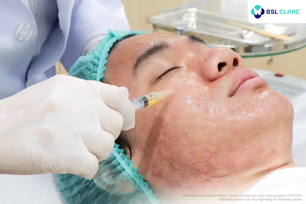 Bioregenerative treatment for acne-damaged skin