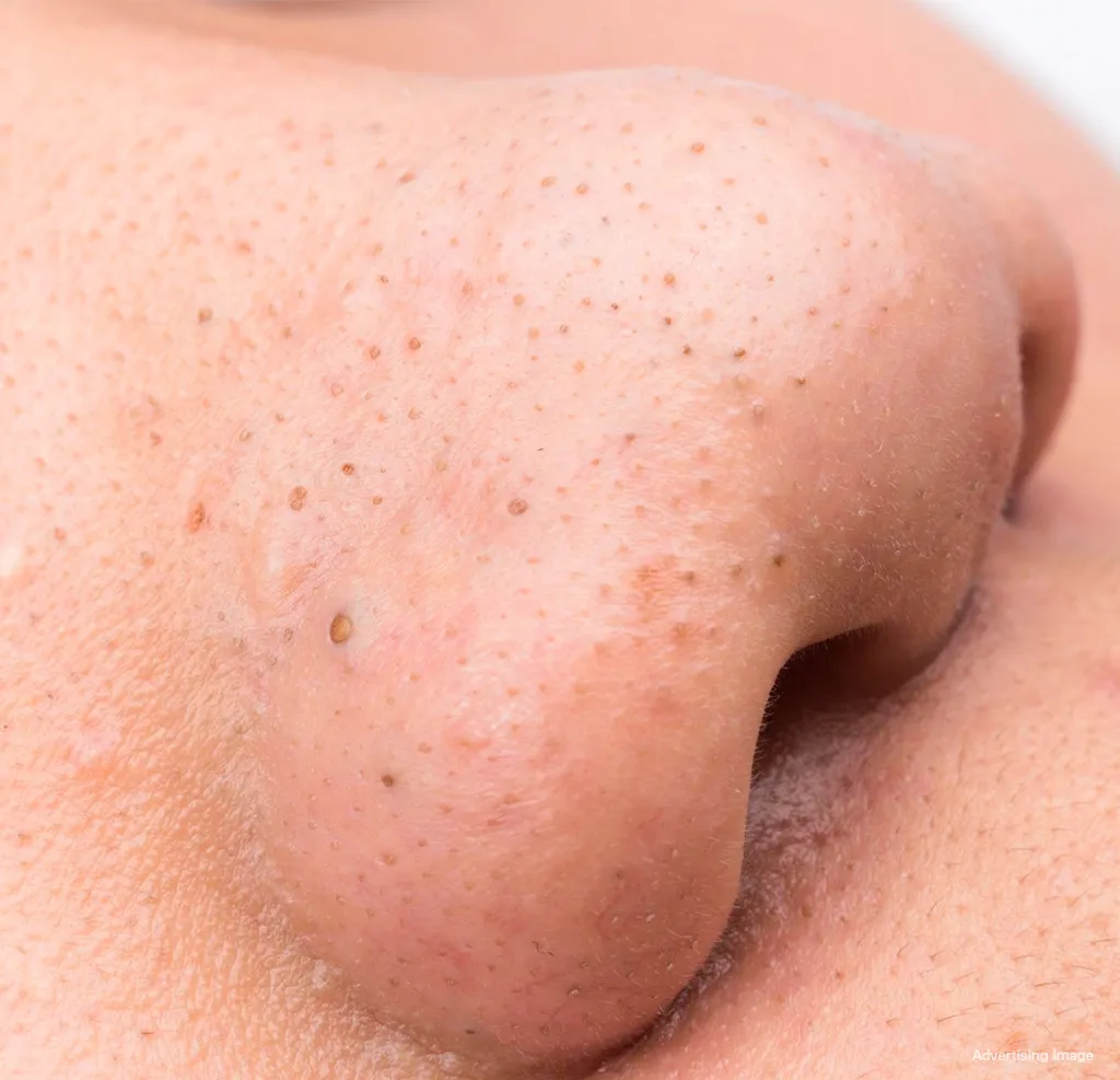 Blackheads on nose: open comedones