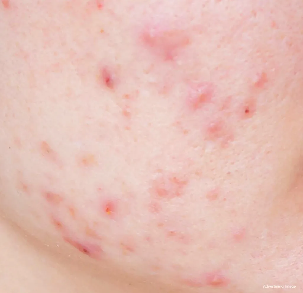 Acne papule: red inflamed bump without pus