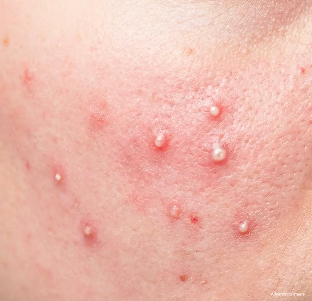 Acne pustule with white head on face