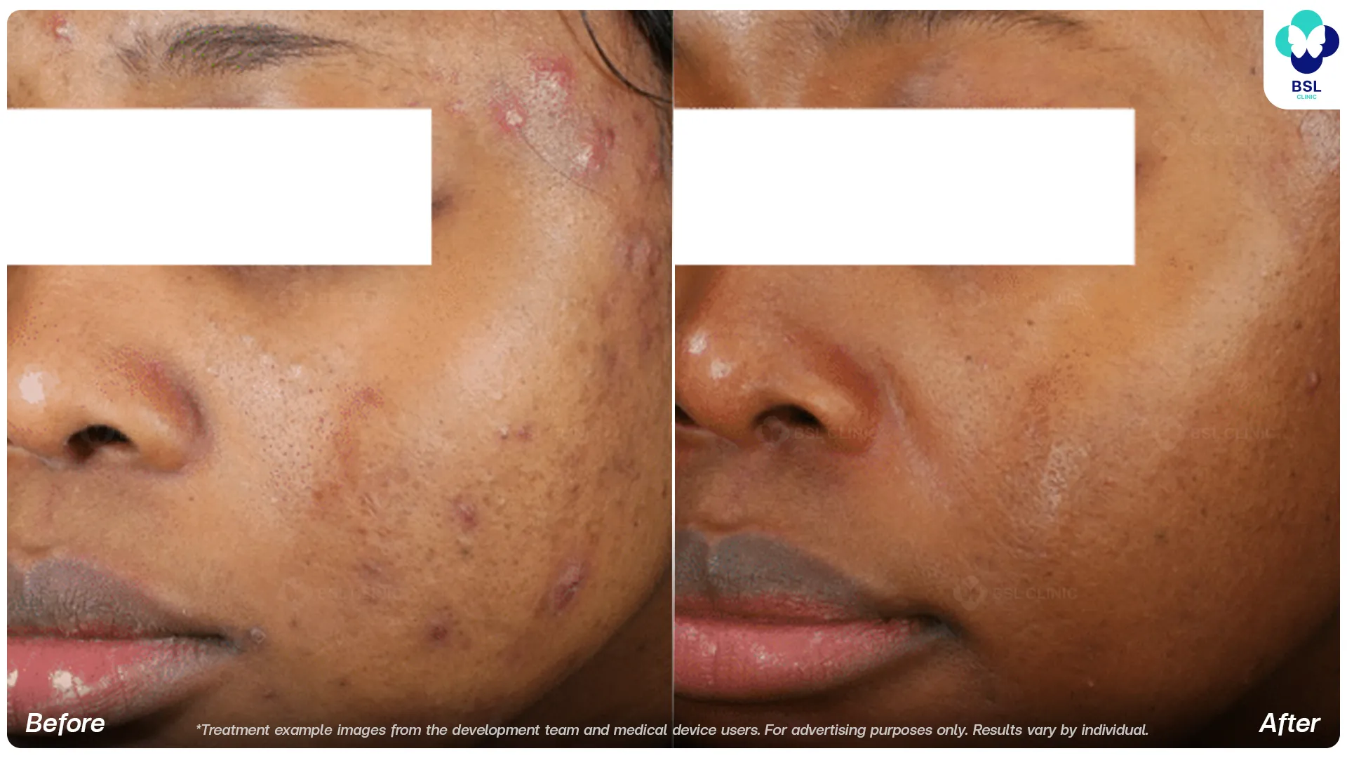 Accure laser before and after acne treatment