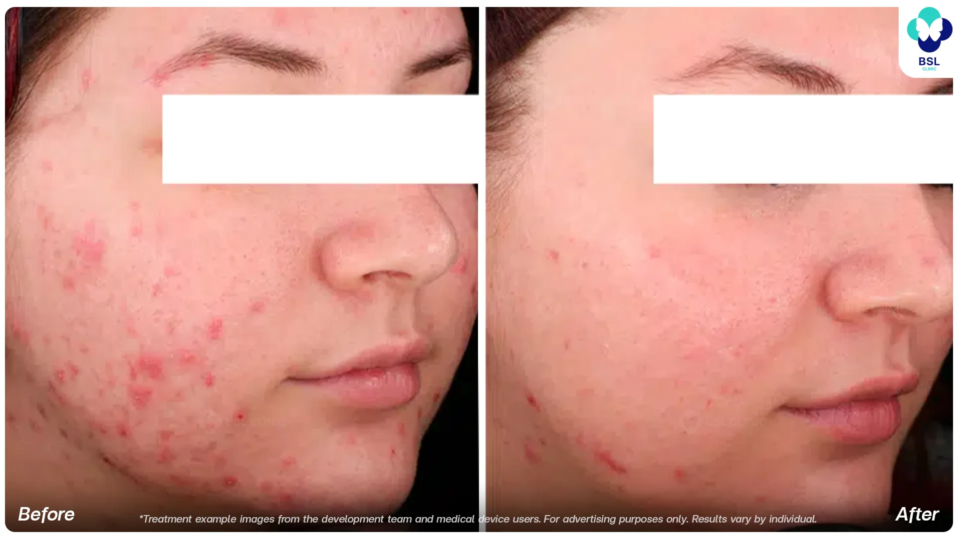 Accure laser before and after acne treatment