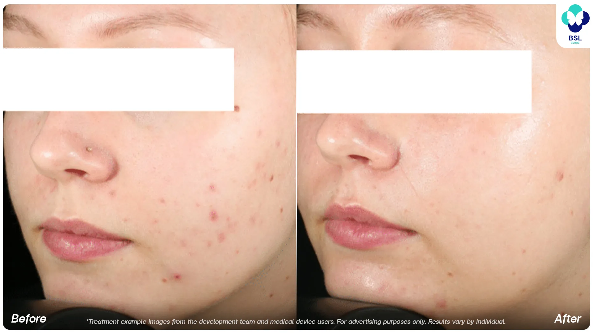 Accure laser before and after acne treatment