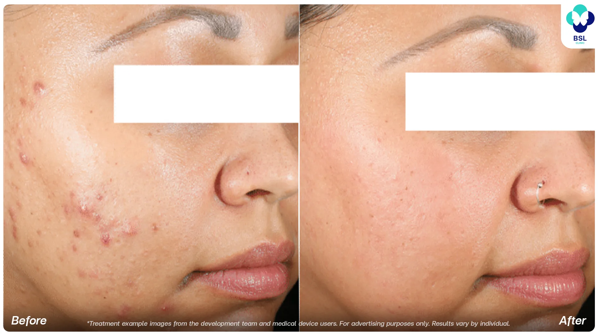 Accure laser before and after acne treatment