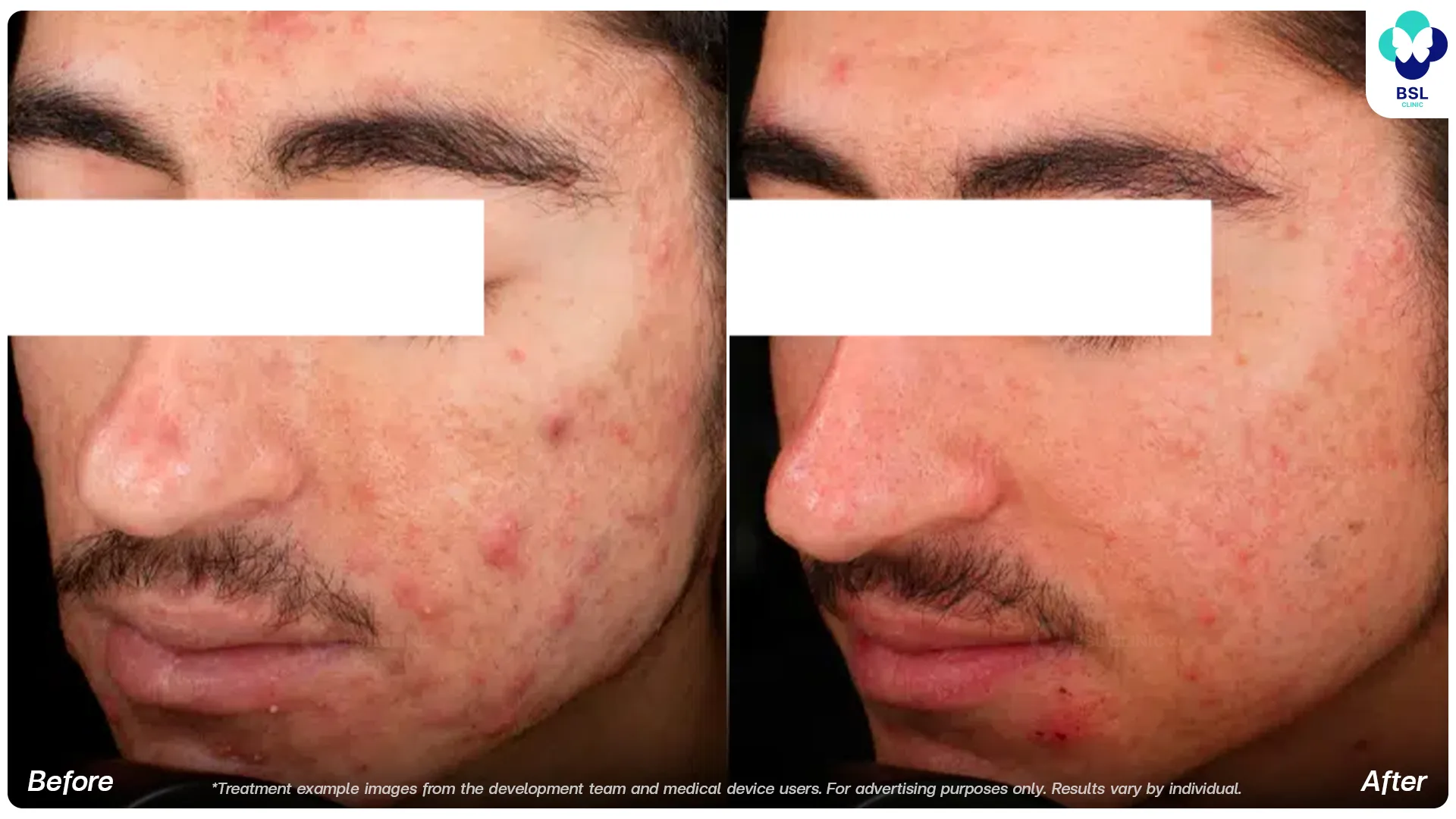 Accure laser before and after acne treatment