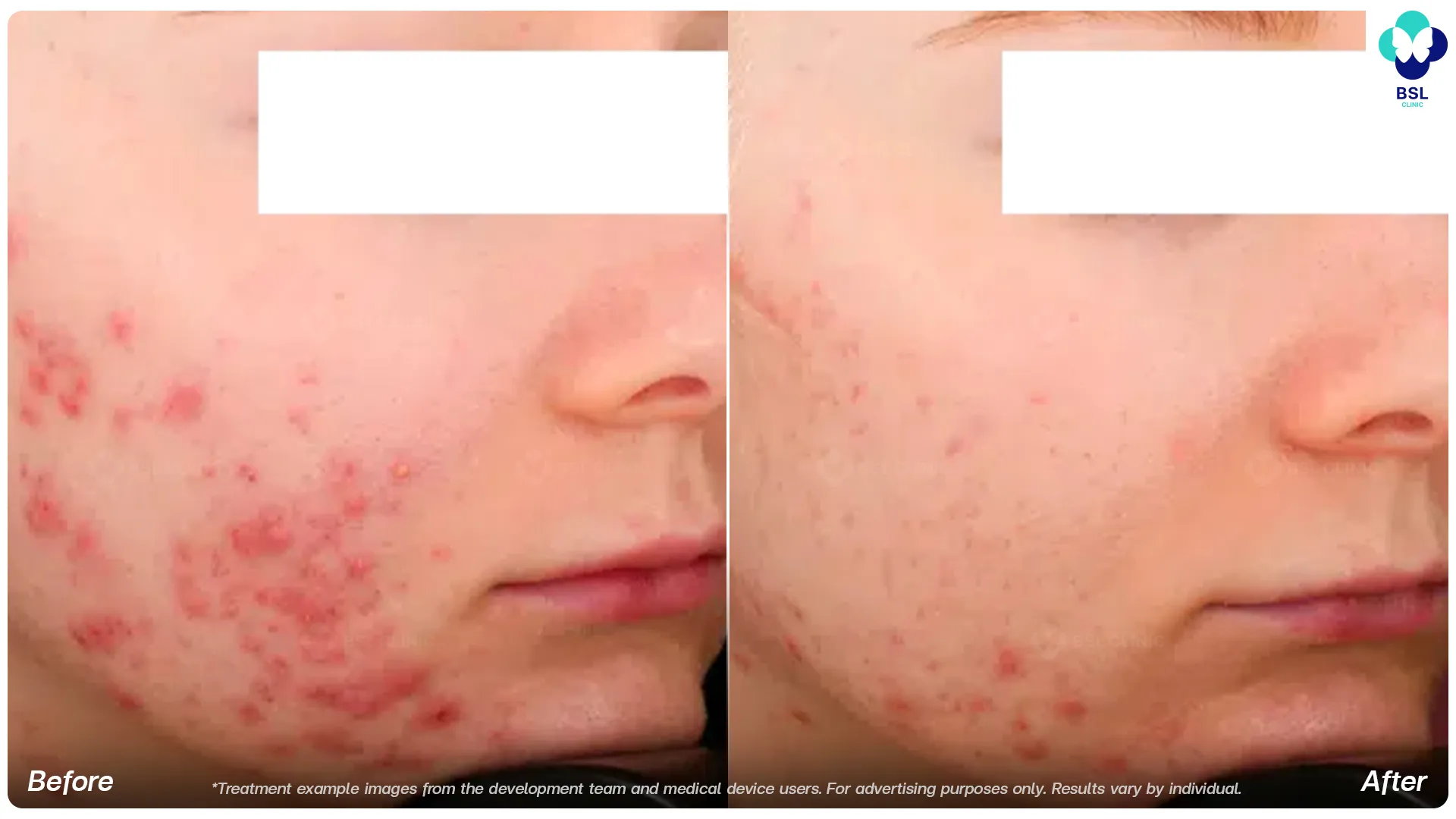 Accure laser before and after acne treatment