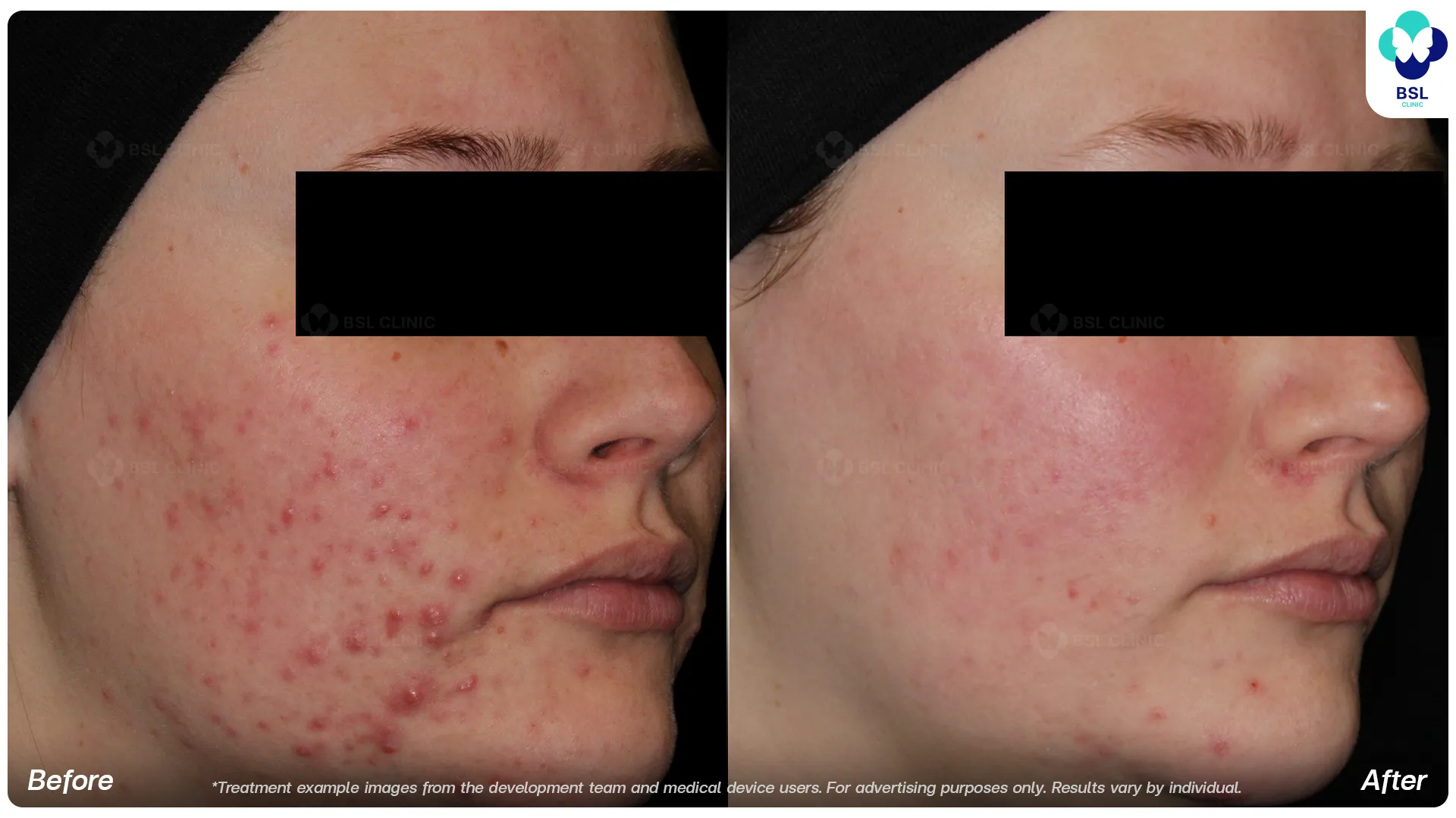 AviClear before and after acne treatment