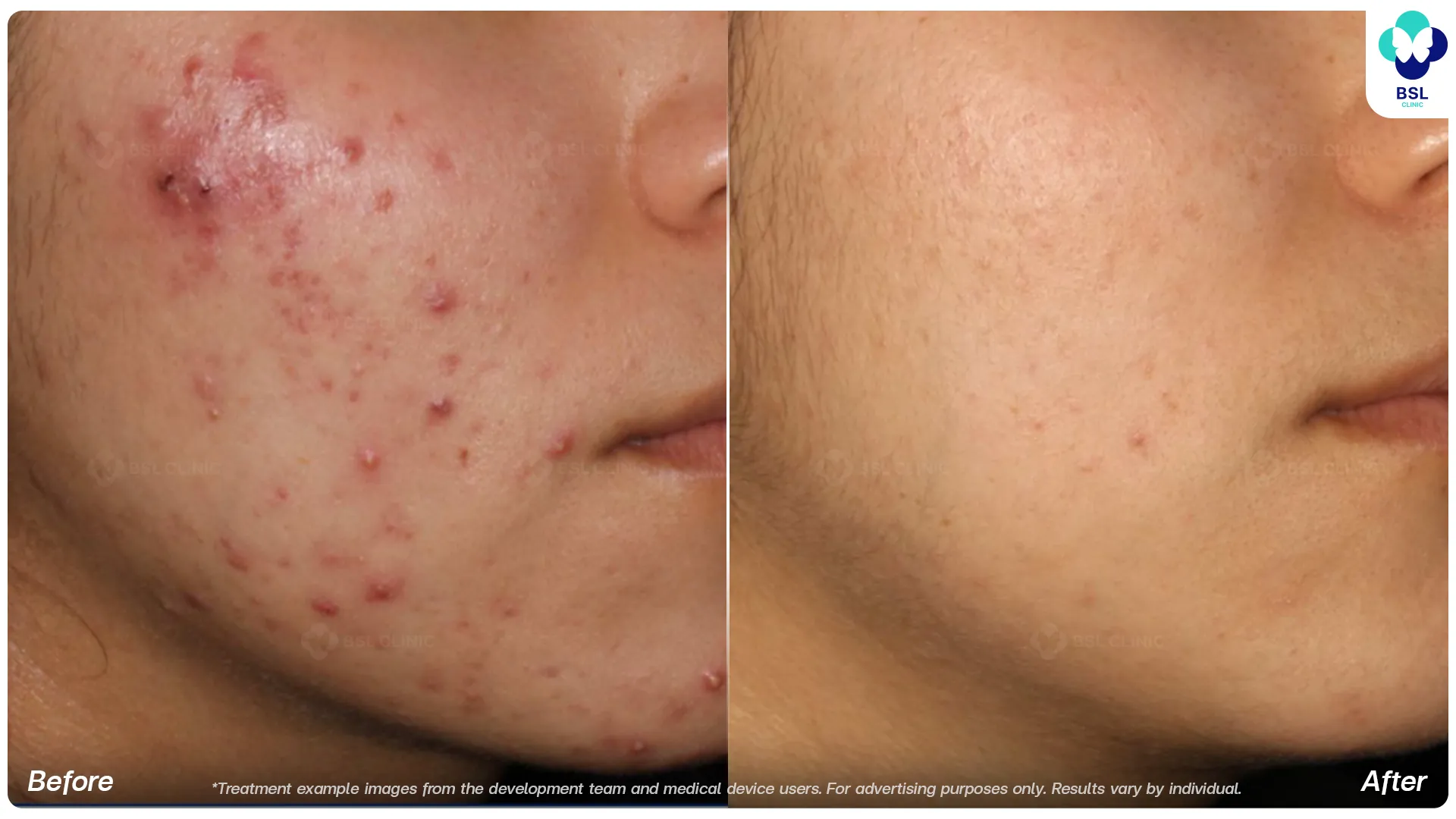 AviClear before and after acne treatment