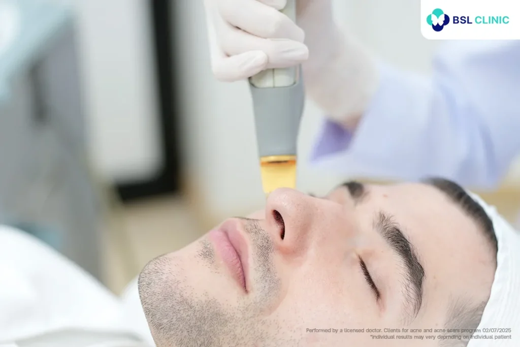 Vascular laser for red acne marks (PIE)